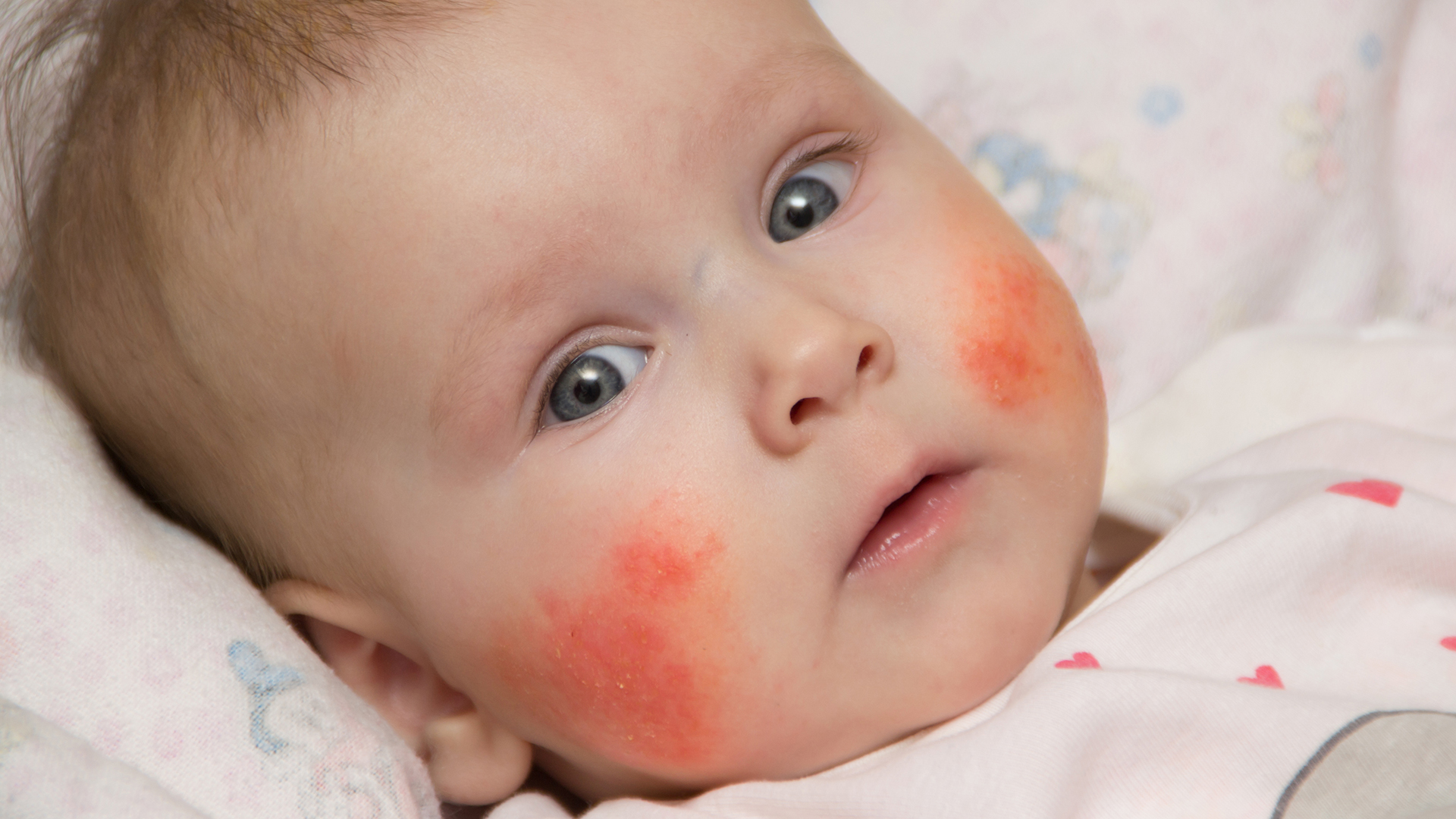 Food Allergies in Babies and Children